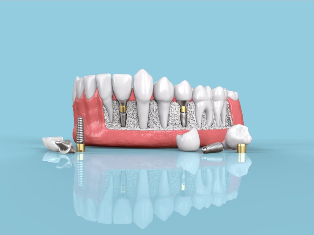 Rendering of model of dental implants