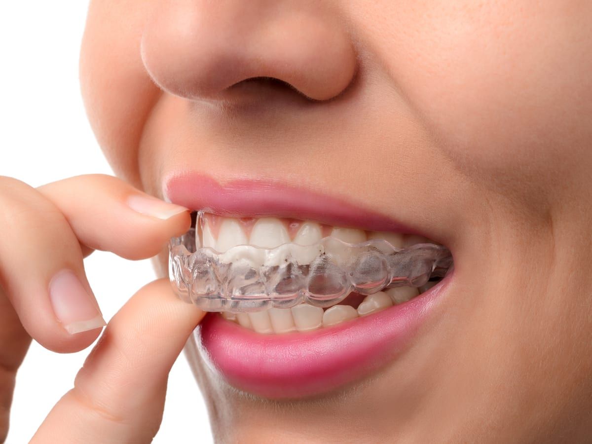 A woman placing in an Invisalign tray.