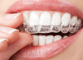 Woman Putting on Invisalign