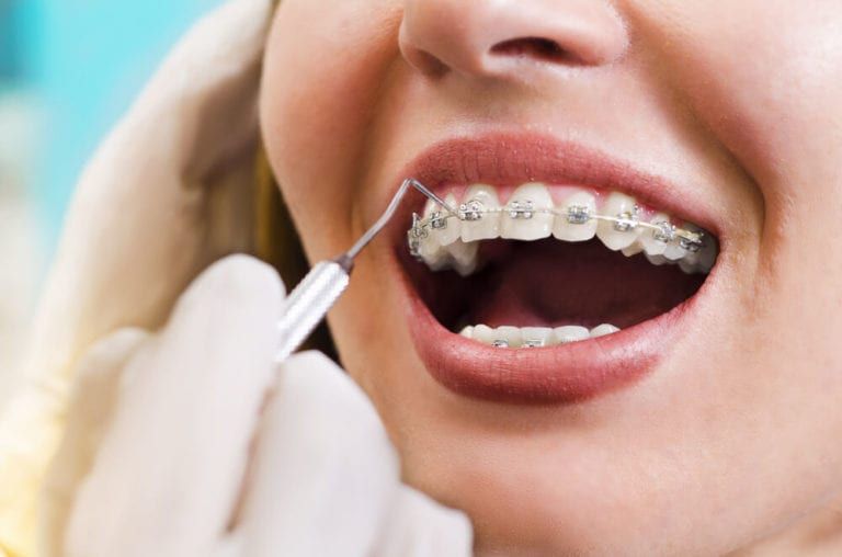 Orthodontist braces