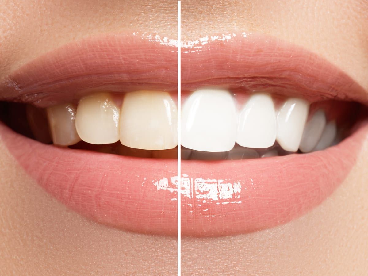 Comparison of pre and post whitening teeth