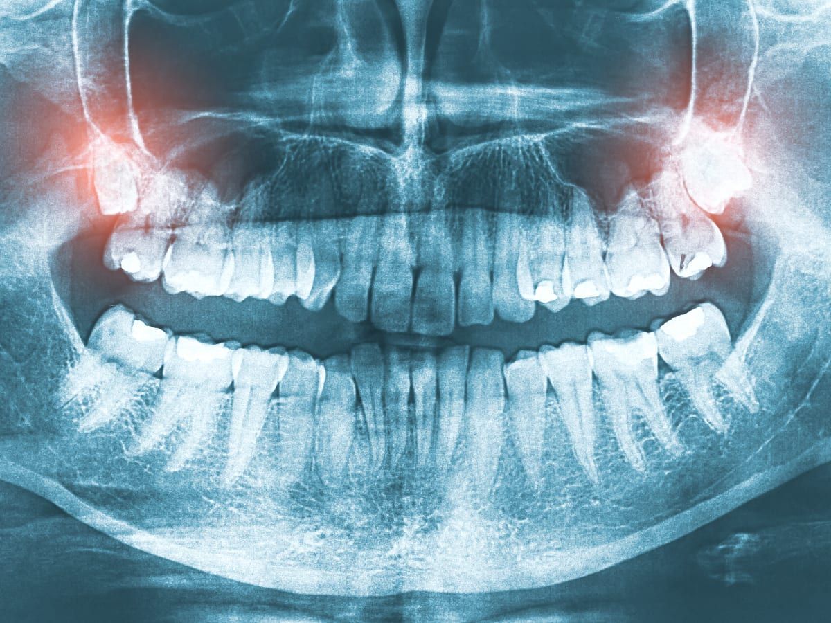 X-Ray with Wisdom Teeth Highlighted In Red