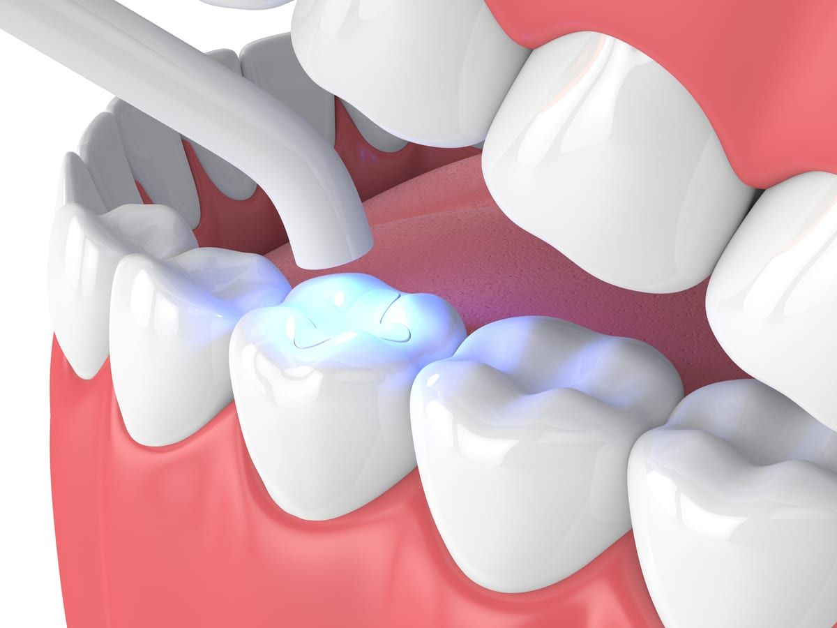 Rendered image of composite fillings being cured with light