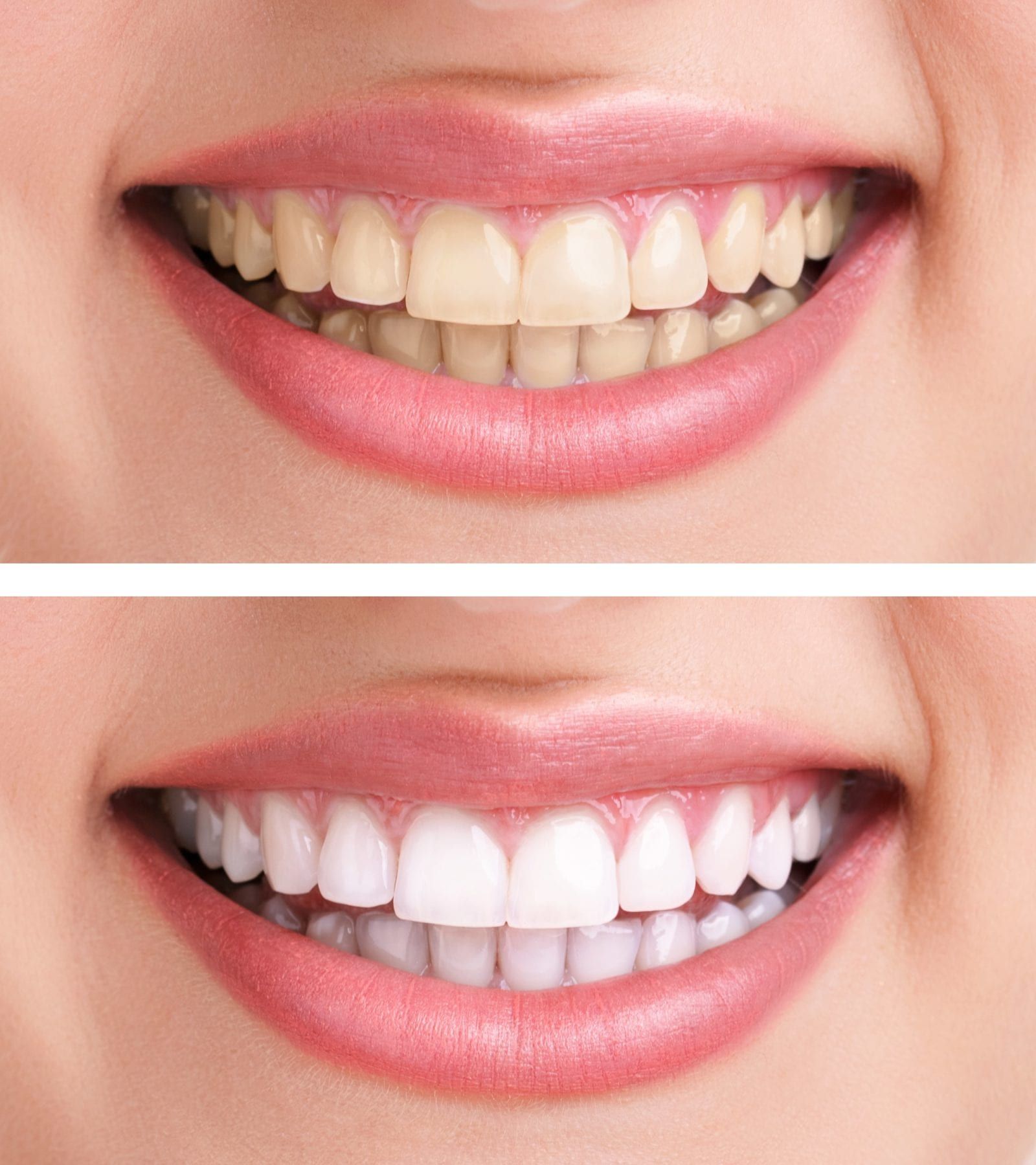 before and after teeth whitening treatment