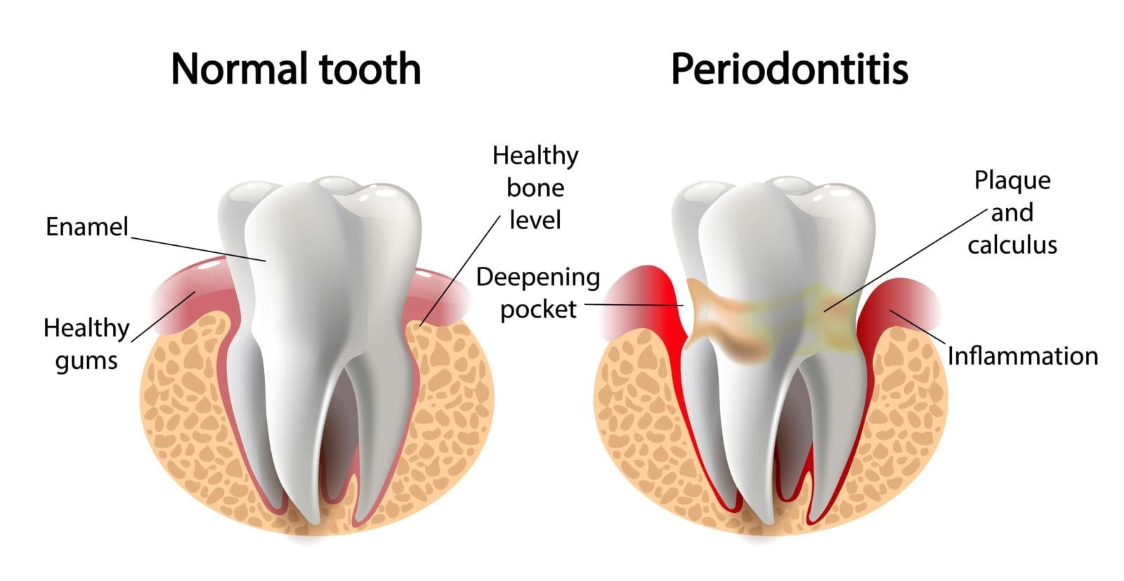 normal tooth shown next to a tooth with gums affected by periodontitis